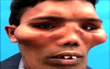 تغییر شکل عجیب صورت مرد جوان در اثر یک عارضه نادر! + فیلم 