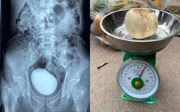 این زن یک سنگ به اندازه سیب زمینی در مثانه‌اش دارد!+عکس