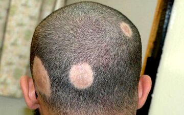 درباره ریزش موی سکه ای بیشتر بدانید