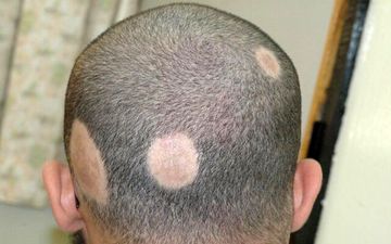 درباره ریزش موی سکه ای بیشتر بدانید