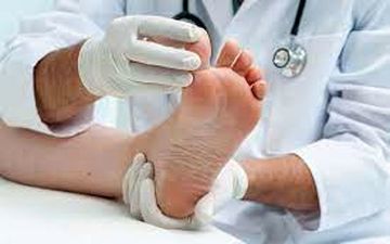 راه های درمان میخچه پا در طب ایرانی