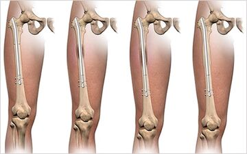 جراحی افزایش قد: آیا خطرناک است؟
