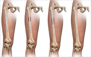 جراحی افزایش قد: آیا خطرناک است؟