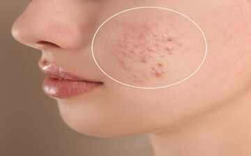 پوست چرب دارید؟ این ۸ باور غلط را دور بریزید